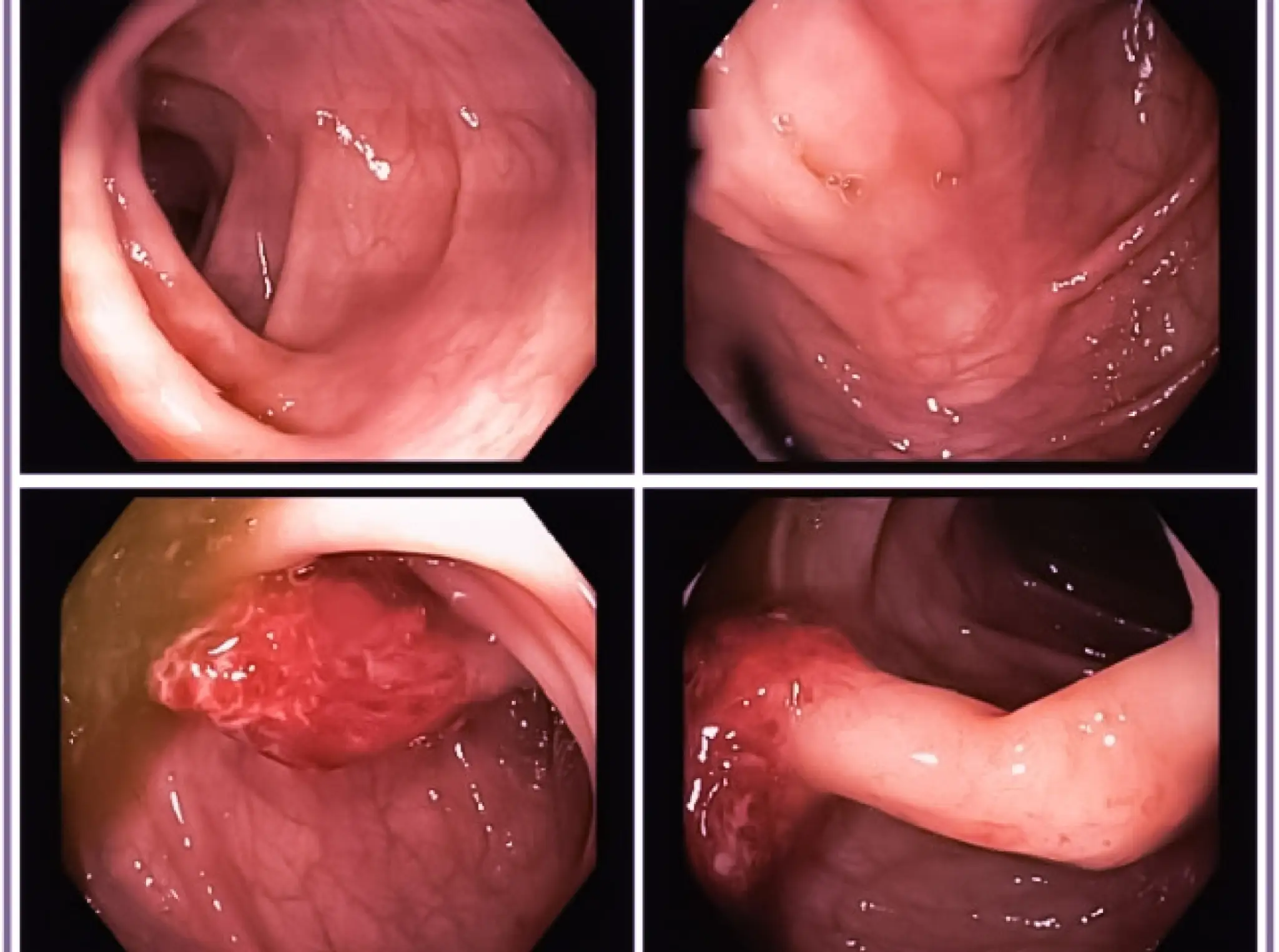 Как очистить кишечник